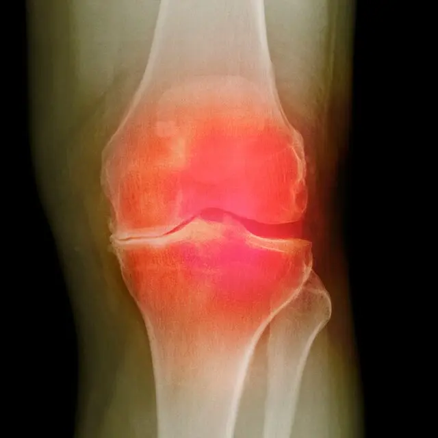 A colored X-ray of a 66-year-old patient with osteoarthritis.